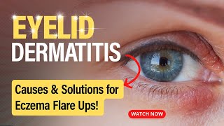 Eyelid Dermatitis Uncovered Causes and Solutions [upl. by Merrick793]