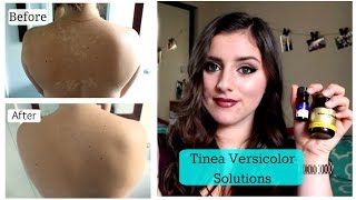 Tinea Versicolor SOLUTIONS TNBeauty94 [upl. by Enimisaj517]