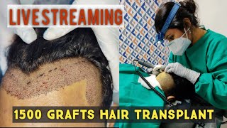 1500 Grafts Hair Line Reconstruction  DrAthira Sreenath amp Team  Hair O Dent Calicut [upl. by Eicrad238]