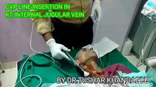 CVP LINE INSERTION IN RTINTRA JUGULAR VEIN [upl. by Emiaj]