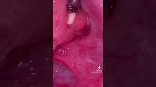 Removal of Tonsil stones [upl. by Sibbie]