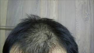 Apple Poly Procyanidin Treatment For Hair Loss  June 2017 [upl. by Rattray]