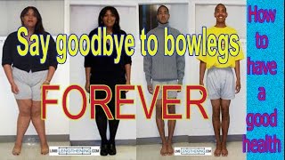 Bow legs treatment  Say goodbye to bowlegs FOREVER [upl. by Airdnaz289]