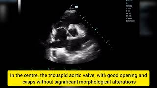 Heart Failure on EchocardiogramInsuficiência Cardíaca no Ecocardiograma [upl. by Halda]