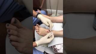 Aspiration and Drainage Cyst from Foot [upl. by Llyrrad]