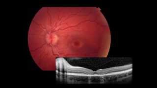 Retina Imaging amp ERG [upl. by Pearlstein]