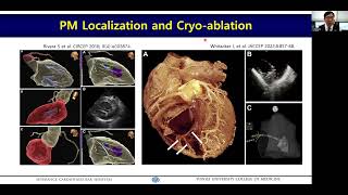 221120 Papillary Muscle VT ABL 박희남 교수 Hui Nam Pak [upl. by Atinek]