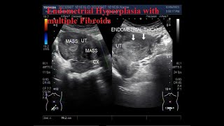 Endometrial Hyperplasia with multiple Fibroids [upl. by Randolf147]