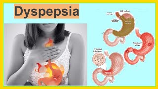 dyspepsia [upl. by Jessi]