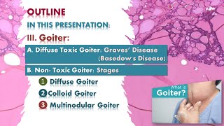 Goiter Graves disease multinodular goiter Thyroid lecture شرح محاضرة [upl. by Queenie758]