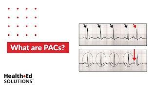 One Quick Question What are PACs Premature Atrial Contractions [upl. by Aniehs]