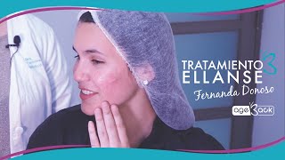 Tratamiento Ellanse para Bioestimulación [upl. by Keene]