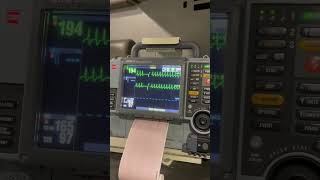 Heart rate 200 Cardioversion with Adenosine [upl. by Wendell285]