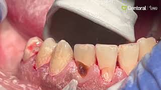 AquaCare Caries Removal [upl. by Niessuh]