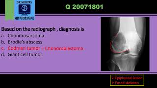 Differentiating epiphyseal lesions Chondroblastoma vs Giant cell tumor [upl. by Cirded]