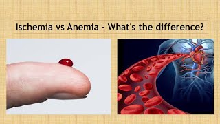 Ischemia vs Anaemia Simple way to learn [upl. by Acinom]