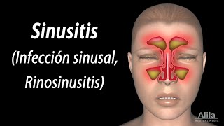 Sinusitis Animación Alila Medical Media Español [upl. by Lukey]