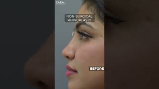 Stunning Transformation Sanas NonSurgical Rhinoplasty Results at Cara Clinic 🌟 [upl. by Bautista]