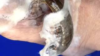 Leech Therapy in skin disease [upl. by Ecirtaeb]