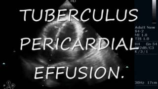 TUBERCULUS PERICARDIAL EFFUSION  ECHOCARDIOGRAPHY SERIES BY DR ANKUR K CHAUDHARI [upl. by Obrien834]