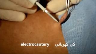 Huge Skin Tag لحمية كبيرة [upl. by Aicinoid]