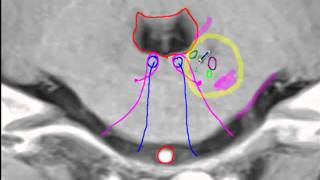 Anterior inferior cerebellar artery [upl. by Peri]