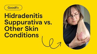 Hidradenitis Suppurativa vs Other Skin Conditions How to Tell the Difference  GoodRx [upl. by Mandle976]