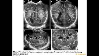 13 Periventricular leukomalacia on neonatal ultrasound white matter injury of prematurity DESHI [upl. by Alayne]