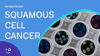 Squamous Cell Cancer Dermatology [upl. by Ahsoyem]