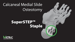 Calcaneal Medial Slide Osteotomy Video [upl. by Katz]