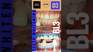 Teeth Whitening In Office 40 min teethwhitening teethcleaning teethwhitener opalescenceboost [upl. by Nahsed268]