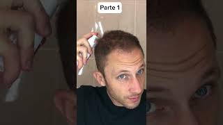 É isso que faço para crescer meu cabelo Como Aplicar Minoxidil para Calvicie Hereditaria Parte 1 [upl. by Irep]