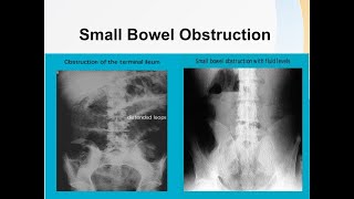 Small bowel obstruction [upl. by Arodnahs]