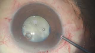 Intumescent Cataract with PXF and shallow AC  Nicking the rhexis and then Recovery [upl. by Inail302]