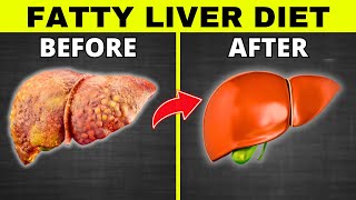 Fatty Liver Diet 5 BEST Foods and 5 To DITCH Meal Plan [upl. by Yvaht]