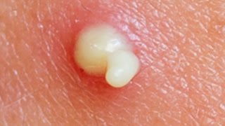 🔍 Pimple Popping Masterclass Safe Acne Removal amp Scar Prevention  2024 Update  TheCoolFactShow [upl. by Aaren]