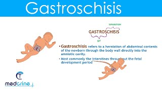 Gastroschisis Definition Causes and Diferences with Omphalocele [upl. by Quintina]