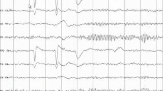 EEG Tutorial [upl. by Inahet]