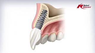 Angulated Screw Channel ASC Abutment [upl. by Tu]