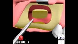 Levantamento de Seio Sinus Lift com Instalação de Implantes Imediatos [upl. by Shandy]