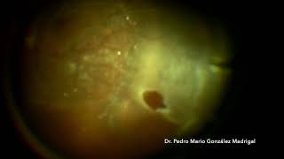 Vitrectomy for Rhegmatogenous Retinal detachment with PVR [upl. by Swayder]