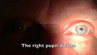 Relative afferent pupillary defect RAPD [upl. by Kresic]