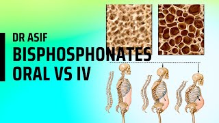 Bisphosphonates Therapy for Osteoporosis how to take  English language [upl. by Nollie]