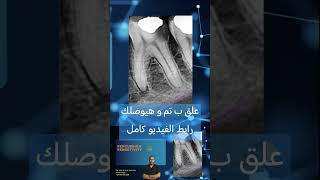 Clinical cases in Endodontics الكربولة endodontics dental [upl. by Nalyk]