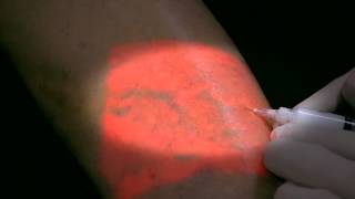 AccuVein Foam Sclerotherapy [upl. by Rebmeced]