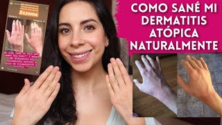 Como Sané mi Dermatitis Atópica sin Medicamentos y de Forma Natural [upl. by Veron]