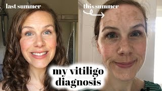 My Vitiligo Diagnosis [upl. by Ameh]