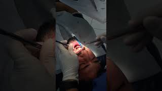 🦷✨ dentalimplants zirkonyum lamine gülüştasarımı hollywoodsmile ortodonti [upl. by Llednor837]