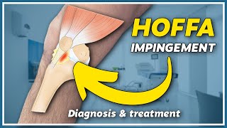 How to diagnose and treat hoffa impingement [upl. by Ainaznat]