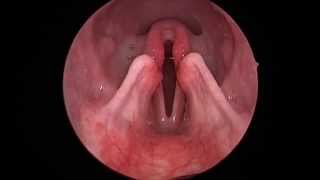 Dog Lar Par Laryngeal paralysis observed in sedated canine oral exam [upl. by Enaillil]